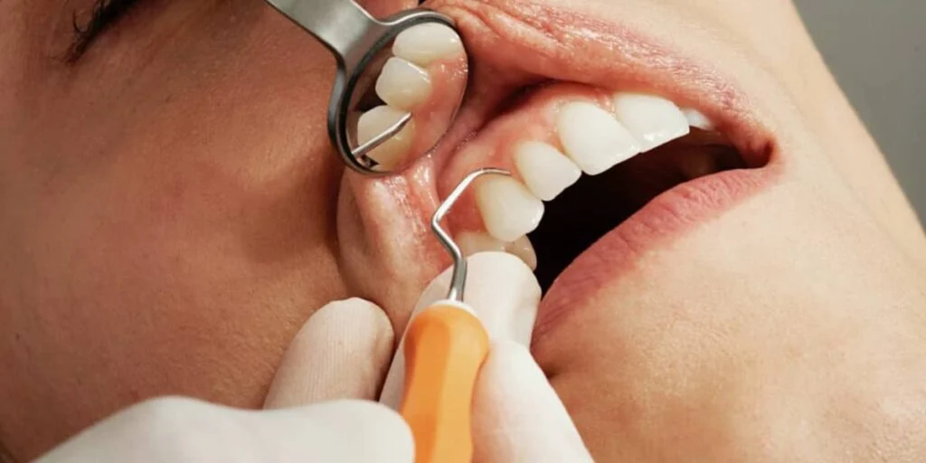 Periodontal Treatment